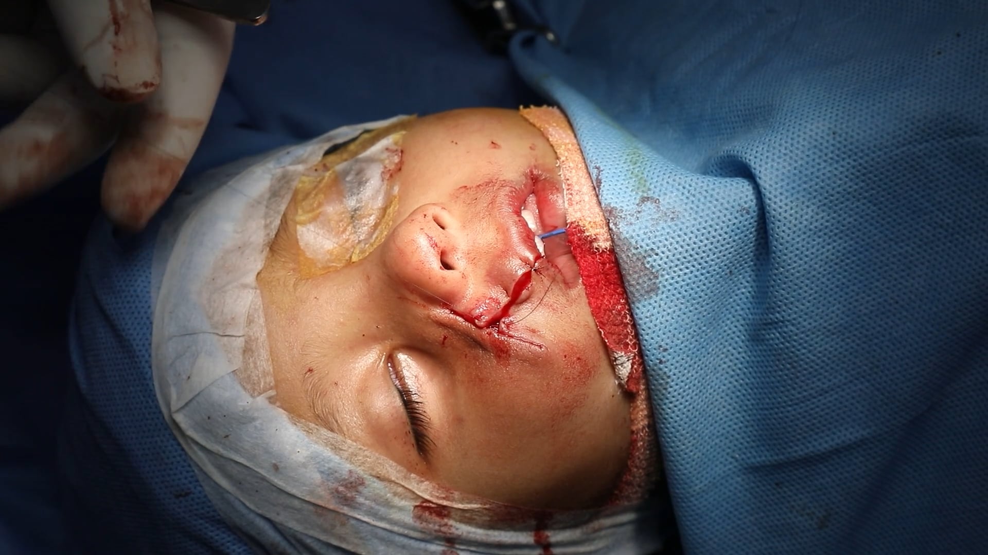 Hemangioma Removal Baby's Face